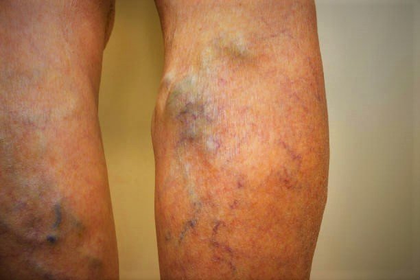 Best Doctor For Varicose Veins In New Delhi
